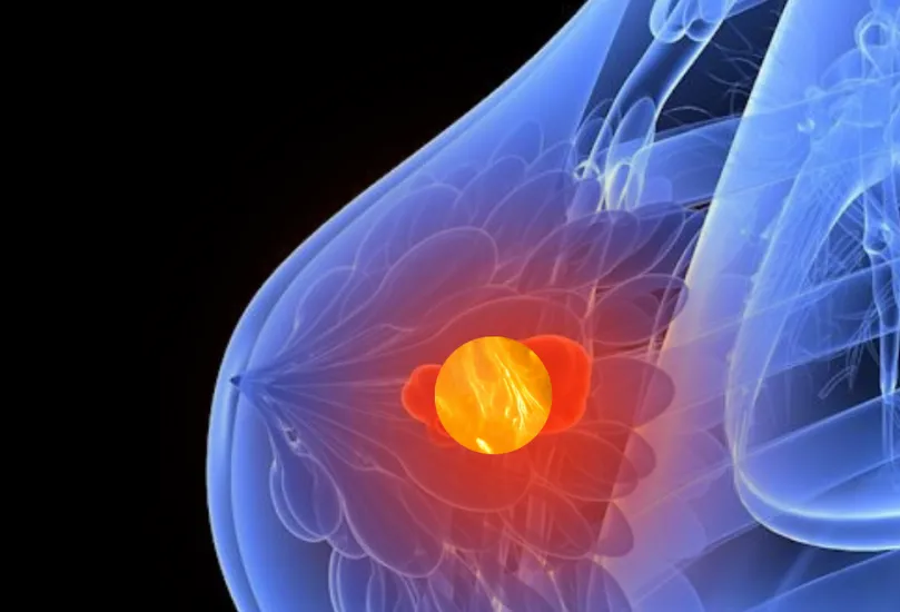 breast_cancer