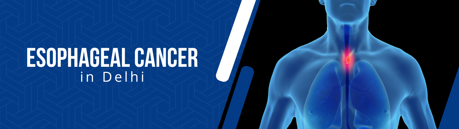 Esophageal_Cancer Esophageal-Cancer