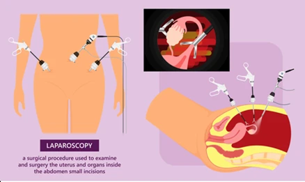 laparoscopy ovarian cancer