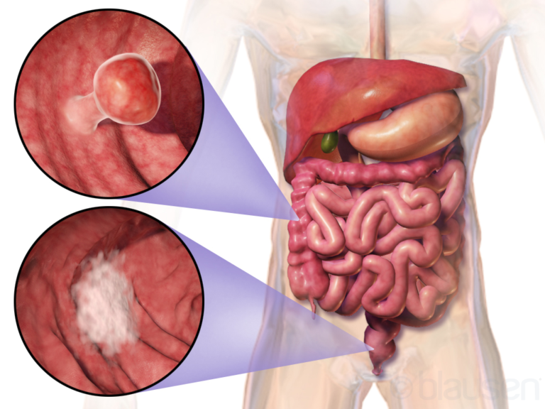 Beyond the Bowels Decoding the Complexity of Colorectal Cancer.