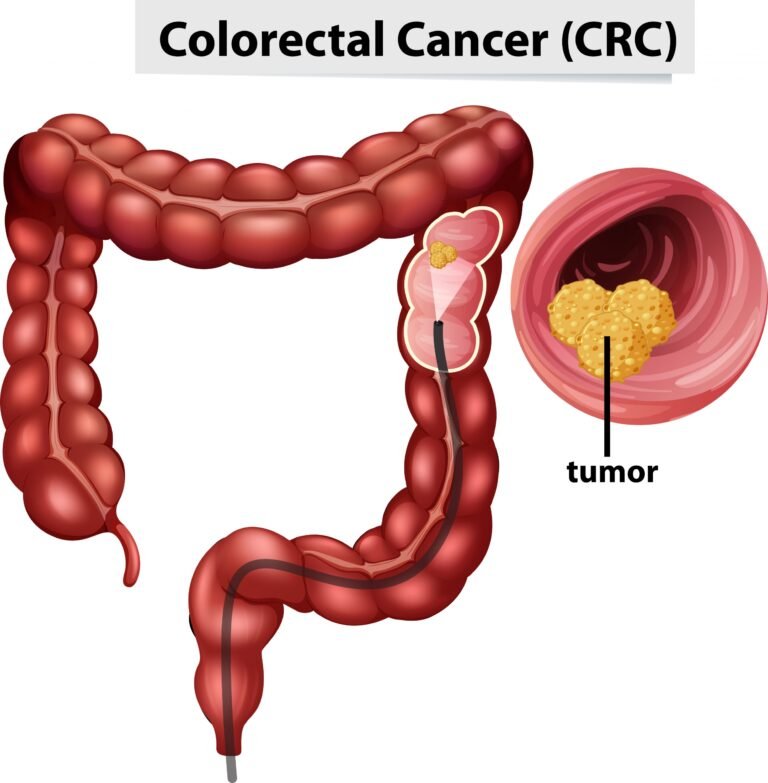 Life After Diagnosis Building Resilience in Colorectal Cancer Survivorship.