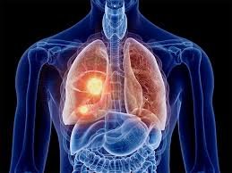 Unveiling the Battle Against Lung Cancer: Understanding Prevention and Treatment