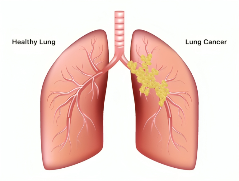 Battling the Silent Threat: Understanding and Confronting Lung Cancer.