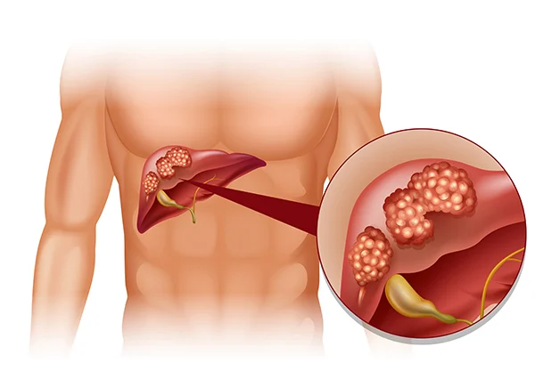 Best Hepatobiliary Cancer Treatment in Wazirpur: Comprehensive Care at Oncologist Prateek Varshney’s Clinic