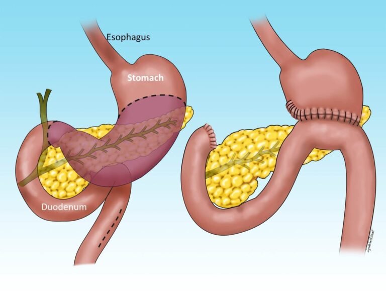 Gastrointestinal Cancer Treatment in Shalimar Bagh: Comprehensive Guide and the Best Approach