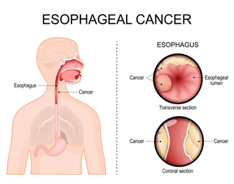 Esophageal-Cancer