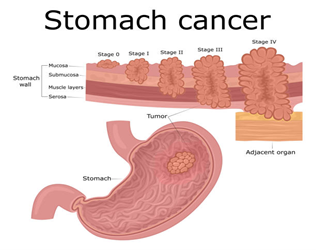 Stomach-cancer