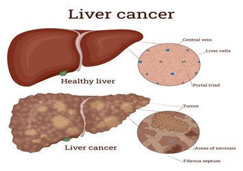 Liver-Cancer