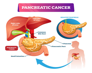 Pancreatic-Cancer