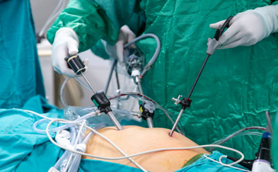 laparoscopy-surgery