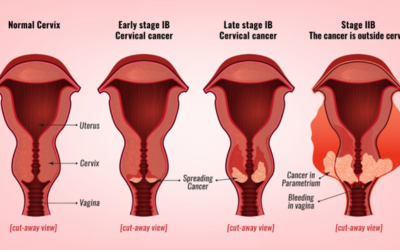 Cancer-Staging-IIV