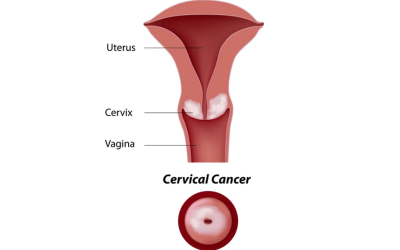Cervical-Cancer- image