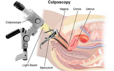 Colposcopy-Hysteroscopy