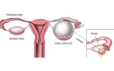 Fallopian-Tube-Cancer-image