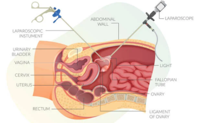 Laparoscopic-Robotic-Surgery