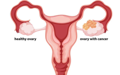 Ovarian-Cancer-image