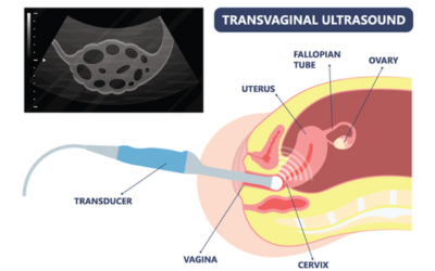Ultrasound-Transvaginal-Scans