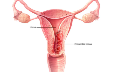 Uterine-Endometrial-Cancer