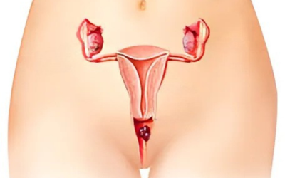Vaginal-Cancer