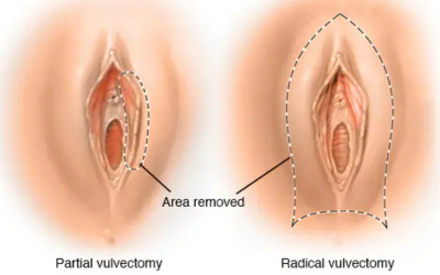 Vulvar-Cancer